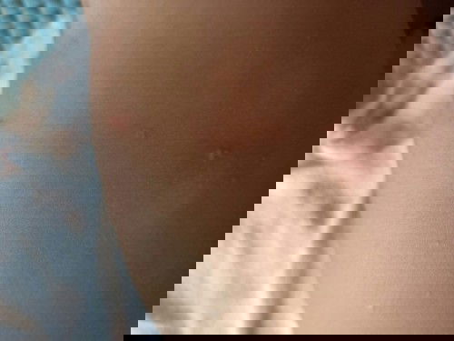 bunda,anaknya ada yang pernah keluar kaya jerawat gini ga di badannya?