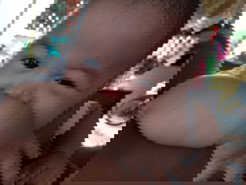 Bayi umur 5 bulan jerawat/ bisul apakah wajar?