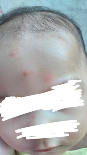 Treatment for my baby