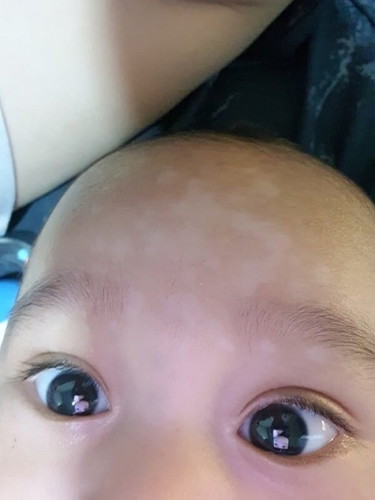 White patches on LO forehead and eyes.