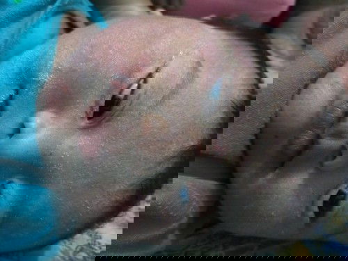 Alergi/eksim/dermatitis