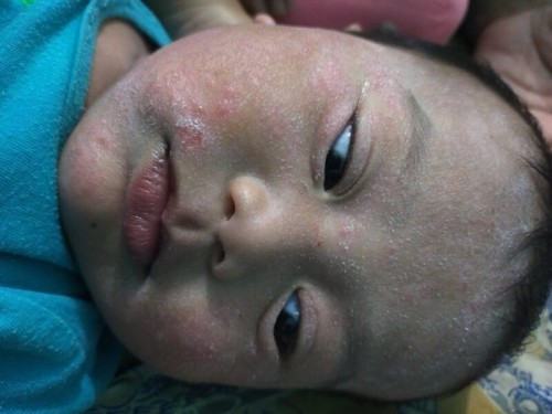 Alergi/eksim/dermatitis
