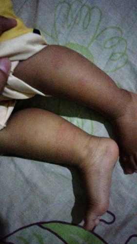 Biduran pada bayi 11 bulan