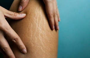 Gimana ya bun ngilangin stretchmark?