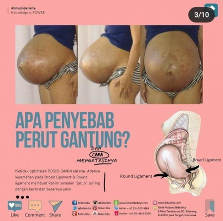 Perut/hamil gantung