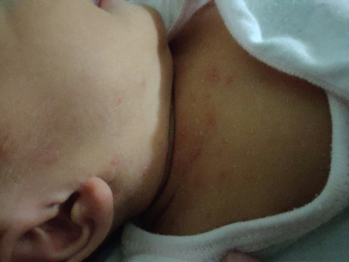 Newborn Rashes