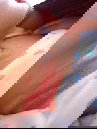 Leher bayi lecet umur 1 bulan 17 hr