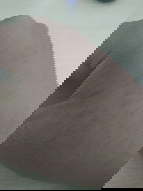 muncul flek-flek hitam di tangan bumil