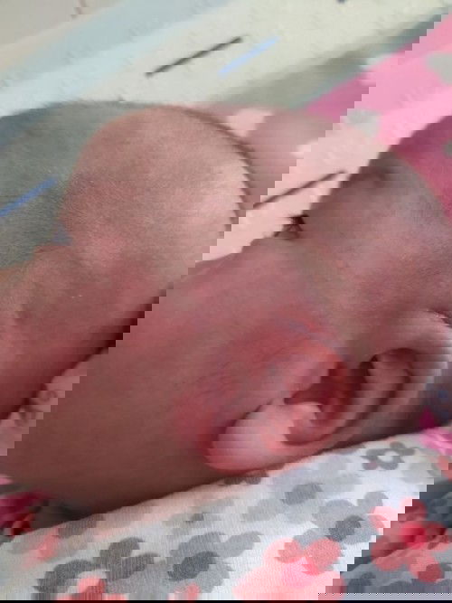 ลูกเป็นผื่นแดงที่แก้มและหัว