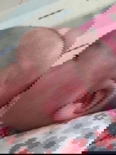 ลูกเป็นผื่นแดงที่แก้มและหัว