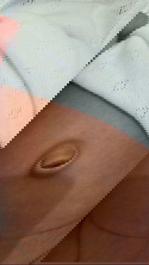 Masalah pusar menonjol