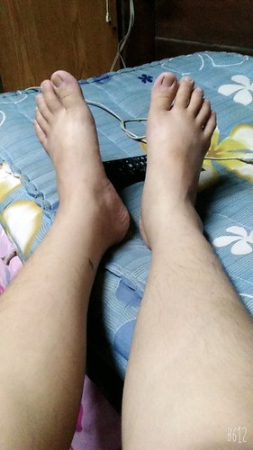 อายุครรภ์ 29สัปดาห์ มีอาการเท้าบวม ถือว่าปกติไหมค่ะ ตัวบวมน้ำหนักขึ้นไวมาก