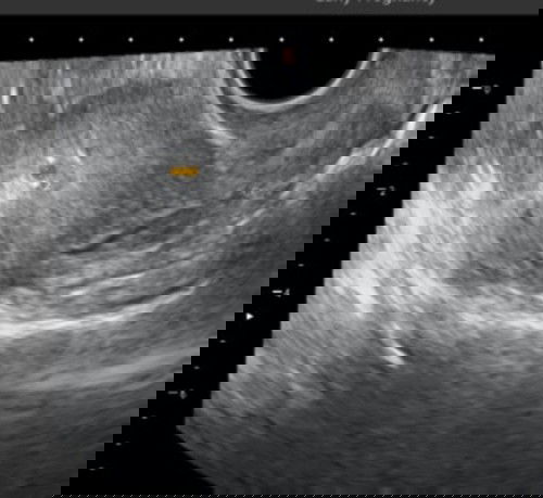 Hamil 5 minggu kantung baru terlihat 0,53 cm apakah normal?