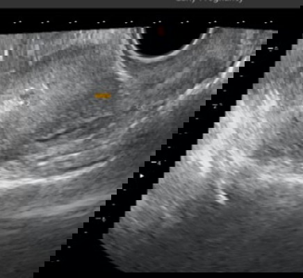 Hamil 5 minggu kantung baru terlihat 0,53 cm apakah normal?