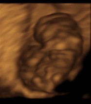 Hasil usg di 9 minggu
