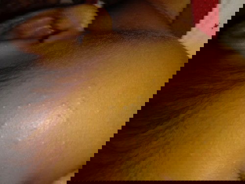 Beruntusan pada bayi