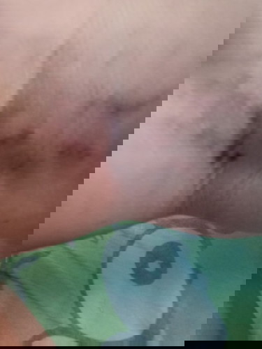 varises