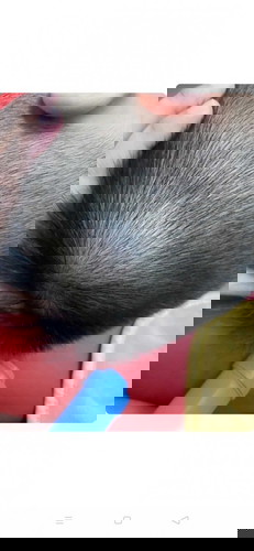 Bump at the back of the head