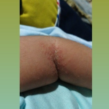 assalamualaikum bun anak ku kena ginian obat apa yang cocok dan bagus ya bunda? trmksh sebelumnya π