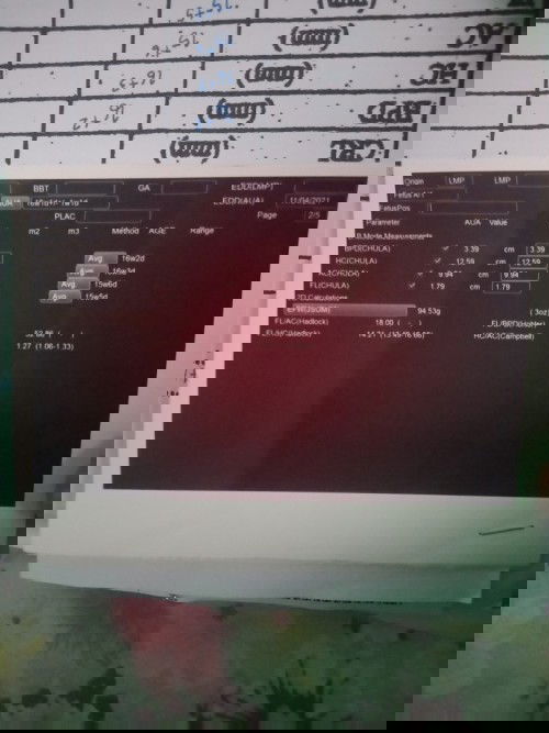 อัลตร้าซาวด์แล้วทำไมไม่มีรูปเด็ก