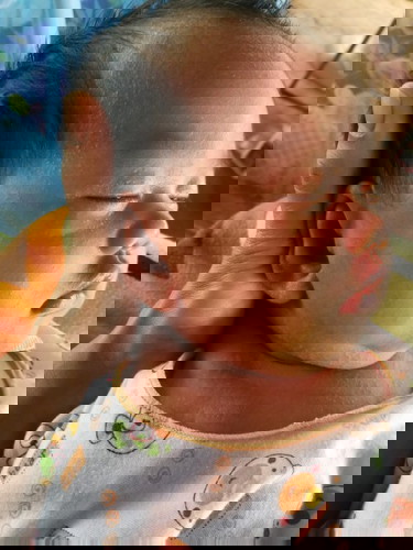 น้องเป็นผื่นแบบนี้รักษายังไงดีคะ