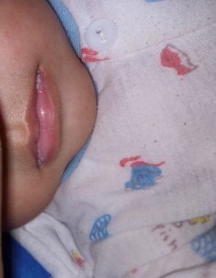 Bercak putih seperti sariawan di bibir