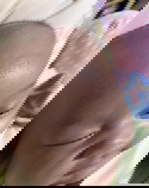 jidat dan pipi bayi bruntusan