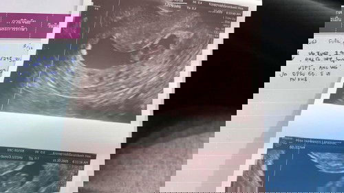 หัวใจน้องไม่เต้น