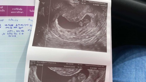 หัวใจน้องไม่เต้น