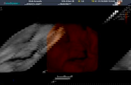 36 week 5 day..HPL november
