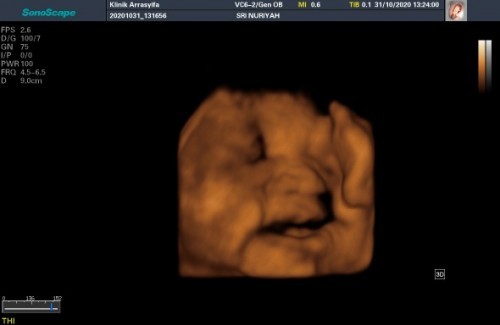 36 week 5 day..HPL november