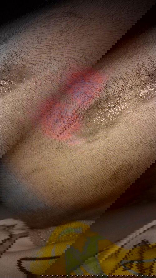 Kata bidan anak saya kena kurap Bun , tapi udh pake salep belum sembuh juga ,