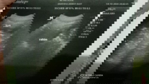 Usg belum kelihatan apa apa