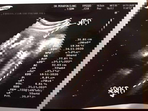 36 วีค 4 วัน ลูกใครกลับหัวแล้วบ้างน้า 👶🏻