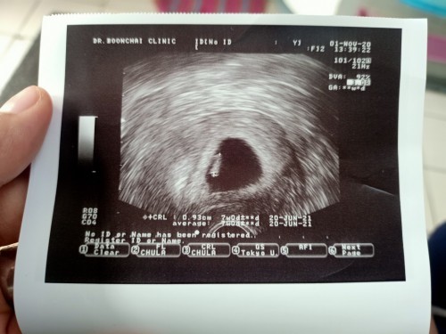 7 Week มีภาวะแท้งคุกคาม