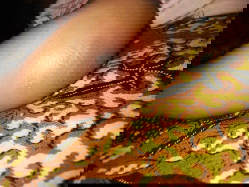 Tangan bengkak merah