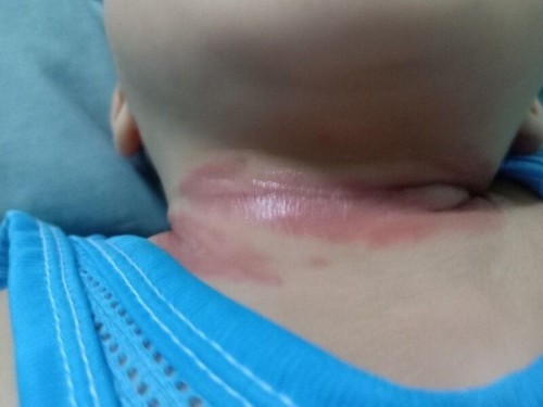 ลูกคอเปื่อย