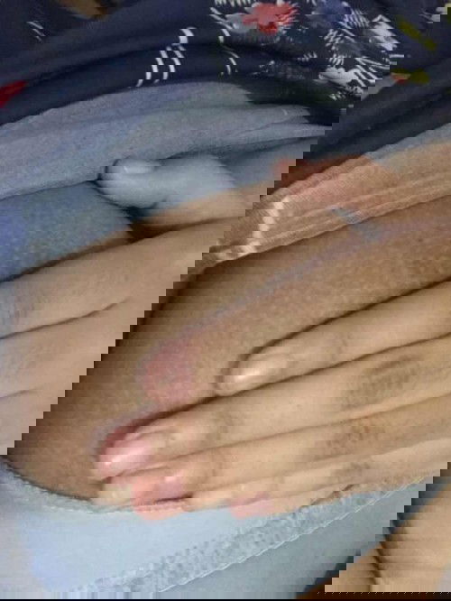 หลังคลอดแล้วหน้าอกลายแล้วดำแบบนี้มีวิธีไหนทำให้หายบ้างค่ะ ไม่ได้ให้นมแล้ว