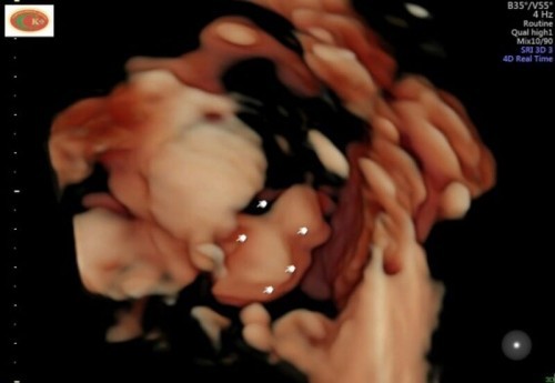 Umur 23week jarang gerak babyny normal gak sih mom ??aku suka kepikiran jdinya