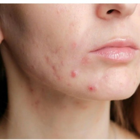 Acne prone skin