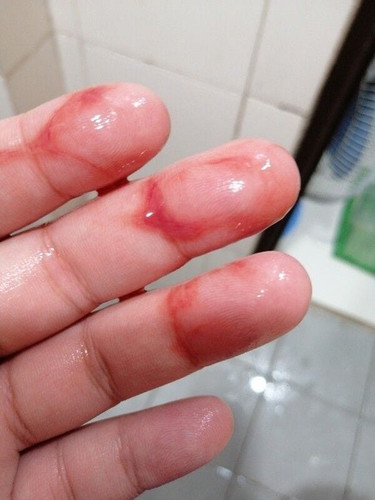 bleeding at 27 weeks