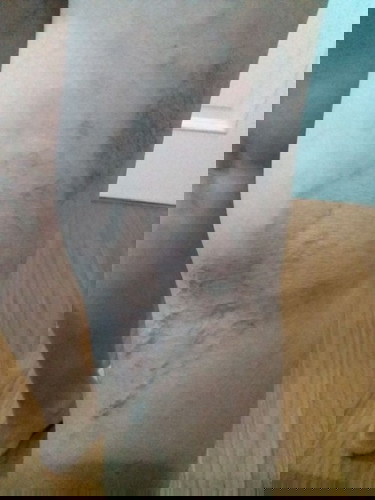 เส้นเลือดขอด