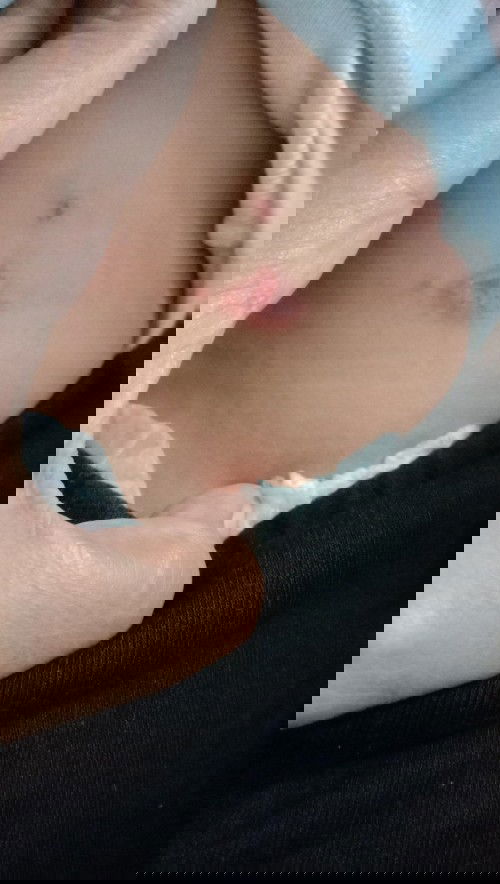 Luka pada bayi....!!!