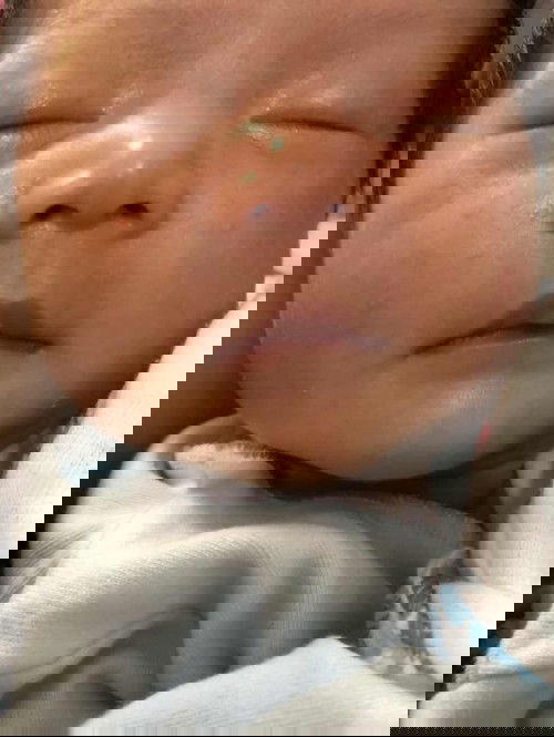 Bintik merah pada wajah bayi