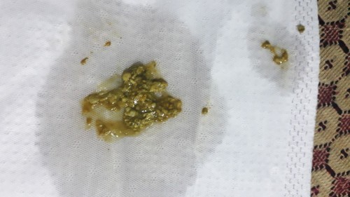 bé bmht đi phân xanh màu mù tạt kèm nhầy. ngày đi khoảng 6 7 lần . như vậy có nên đi khám k các m