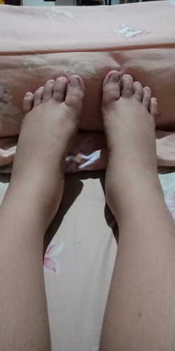 bun.. penyebab kaki dan tangan bengkak selama hamil itu apa ya? bahaya gak sih?