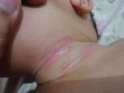 rashes po sa leeg na namamasa. ano po kaya puede gawin?
thanks po sa sasagot. God bless