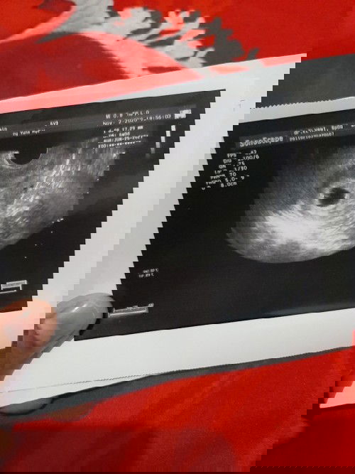 USG kehamilan 6 week