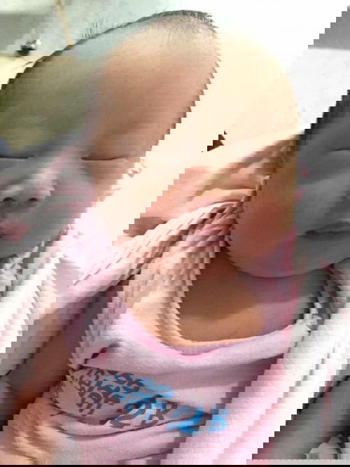 โดนผ่าเพราะลูกกลับหัว แต่ไม่ลงอุ้งเชิงกราน