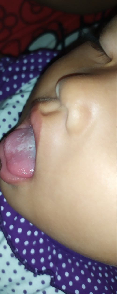 Sariawan pada bayi